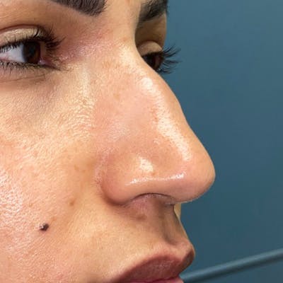 Rhinoplasty Before & After Gallery - Patient 247321 - Image 1
