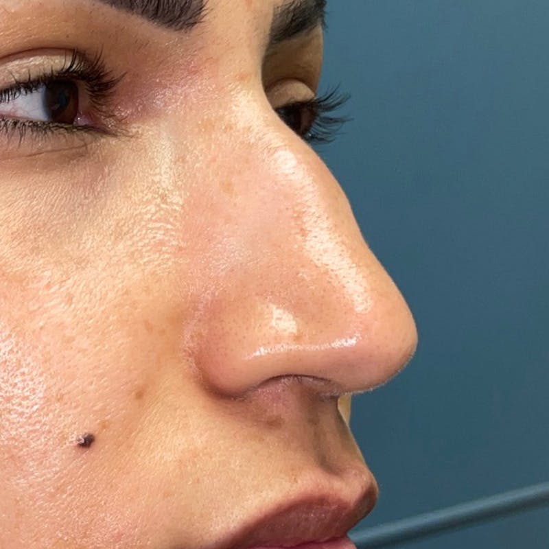 Rhinoplasty Before & After Gallery - Patient 247321 - Image 1
