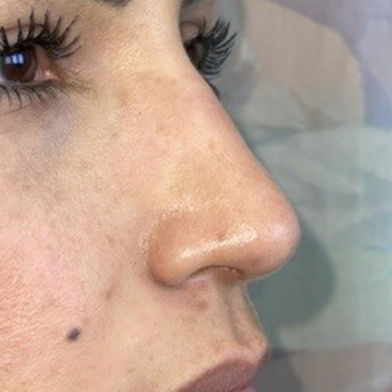Rhinoplasty Before & After Gallery - Patient 247321 - Image 2