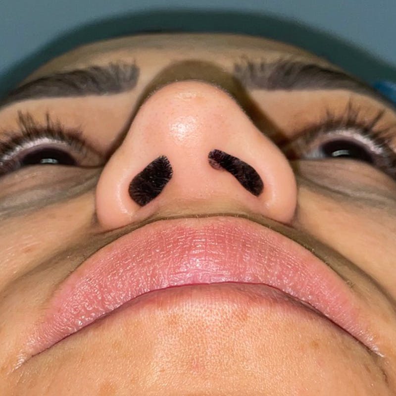 Rhinoplasty Before & After Gallery - Patient 247321 - Image 3