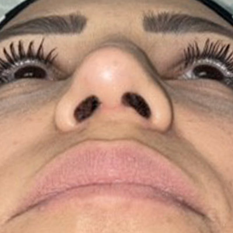 Rhinoplasty Before & After Gallery - Patient 247321 - Image 4