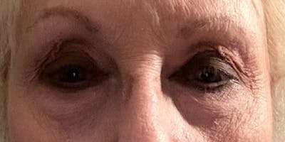 Blepharoplasty Before & After Gallery - Patient 269856 - Image 1