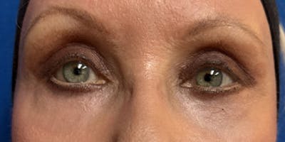 Blepharoplasty Before & After Gallery - Patient 269856 - Image 2