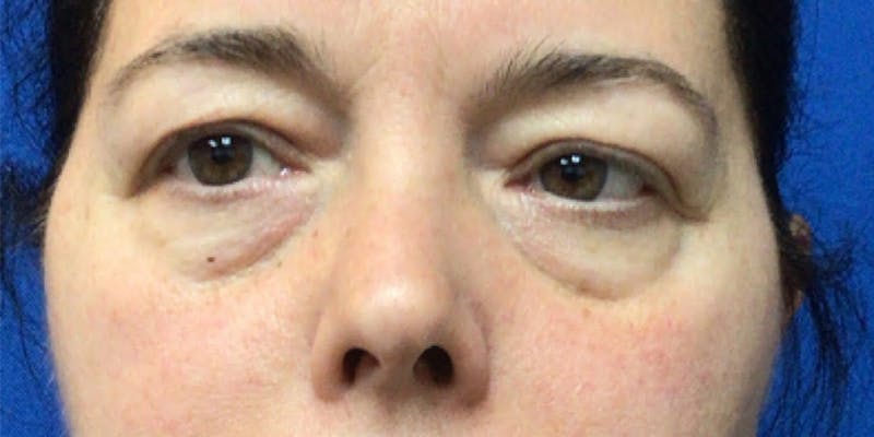 Blepharoplasty Before & After Gallery - Patient 385557 - Image 1