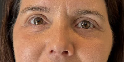 Blepharoplasty Before & After Gallery - Patient 385557 - Image 2