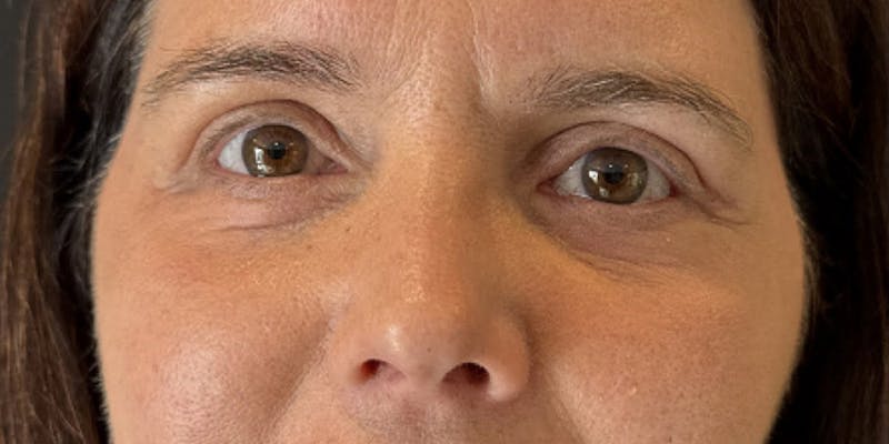Blepharoplasty Before & After Gallery - Patient 385557 - Image 2