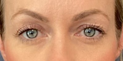 Blepharoplasty Before & After Gallery - Patient 114263 - Image 1