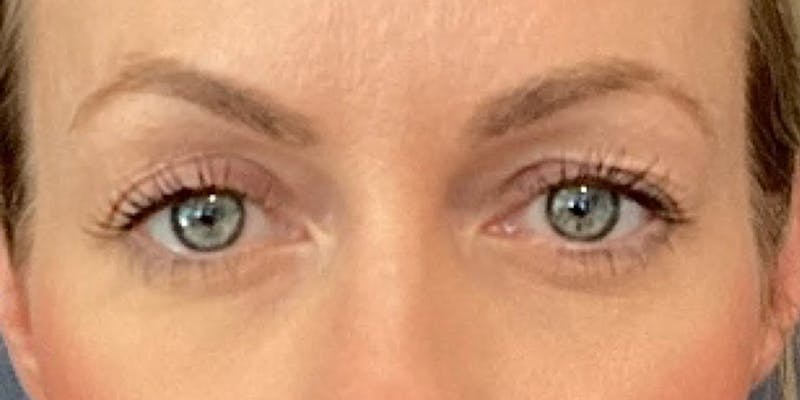 Blepharoplasty Before & After Gallery - Patient 114263 - Image 1