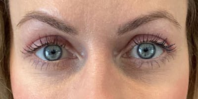 Blepharoplasty Before & After Gallery - Patient 114263 - Image 2
