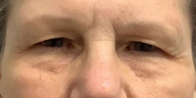 Blepharoplasty Before & After Gallery - Patient 276776 - Image 1