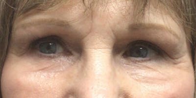 Blepharoplasty Before & After Gallery - Patient 276776 - Image 2