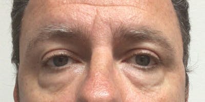 Blepharoplasty Before & After Gallery - Patient 375894 - Image 1