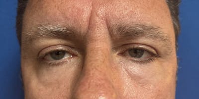 Blepharoplasty Before & After Gallery - Patient 375894 - Image 2