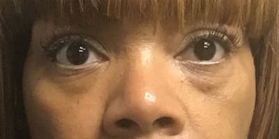 Blepharoplasty Before & After Gallery - Patient 120956 - Image 1