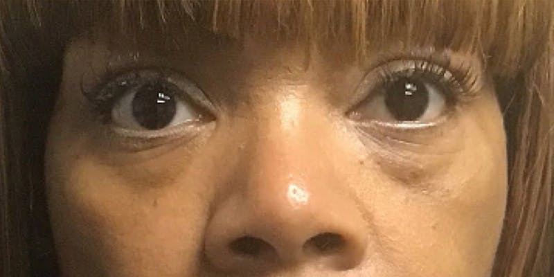 Blepharoplasty Before & After Gallery - Patient 120956 - Image 1