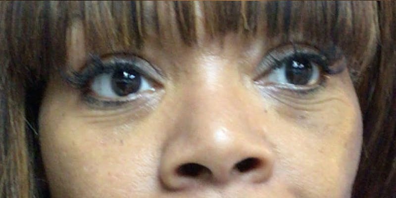 Blepharoplasty Before & After Gallery - Patient 120956 - Image 2