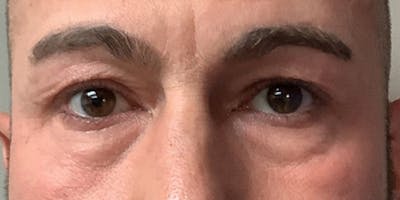 Blepharoplasty Before & After Gallery - Patient 325464 - Image 1
