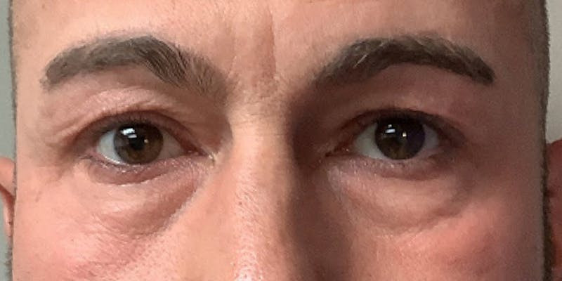 Blepharoplasty Before & After Gallery - Patient 325464 - Image 1