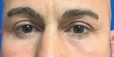 Blepharoplasty Before & After Gallery - Patient 325464 - Image 2
