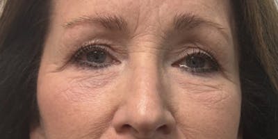 Blepharoplasty Before & After Gallery - Patient 418080 - Image 1