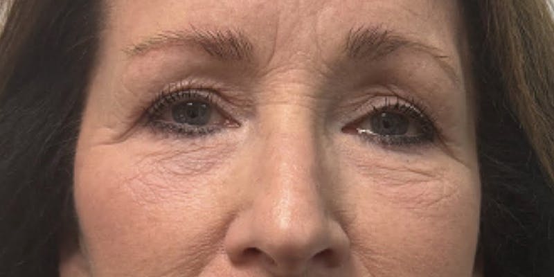 Blepharoplasty Before & After Gallery - Patient 418080 - Image 1