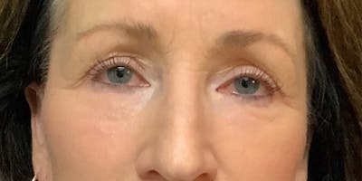 Blepharoplasty Before & After Gallery - Patient 418080 - Image 2