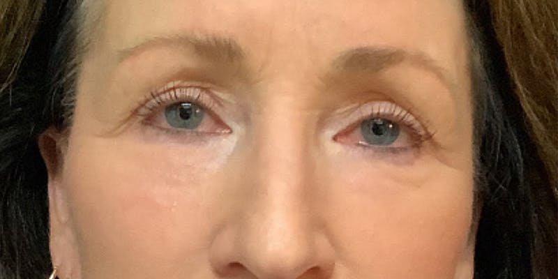 Blepharoplasty Before & After Gallery - Patient 418080 - Image 2