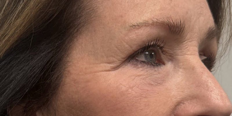 Blepharoplasty Before & After Gallery - Patient 418080 - Image 3