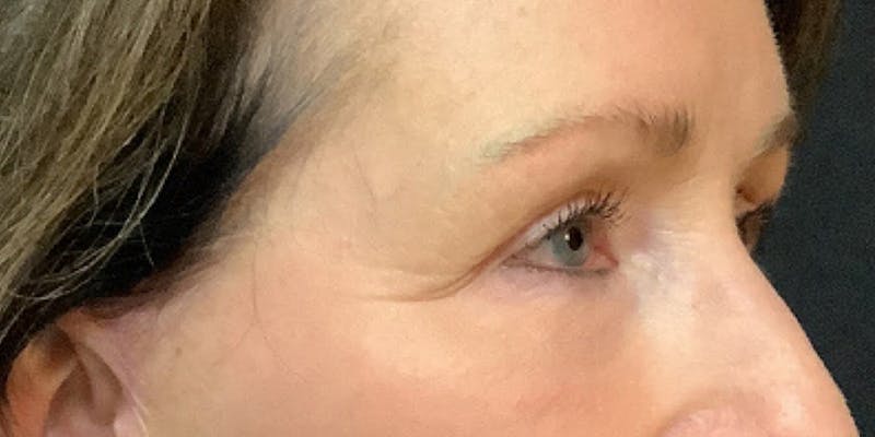 Blepharoplasty Before & After Gallery - Patient 418080 - Image 4