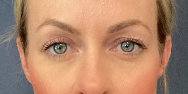 Blepharoplasty Before & After Gallery - Patient 317384 - Image 1