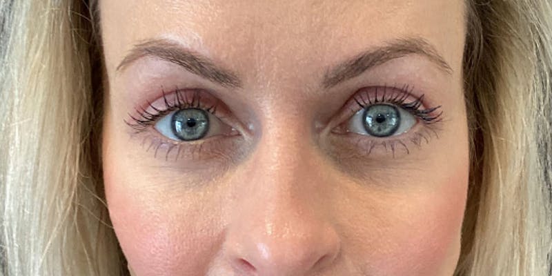 Blepharoplasty Before & After Gallery - Patient 317384 - Image 2