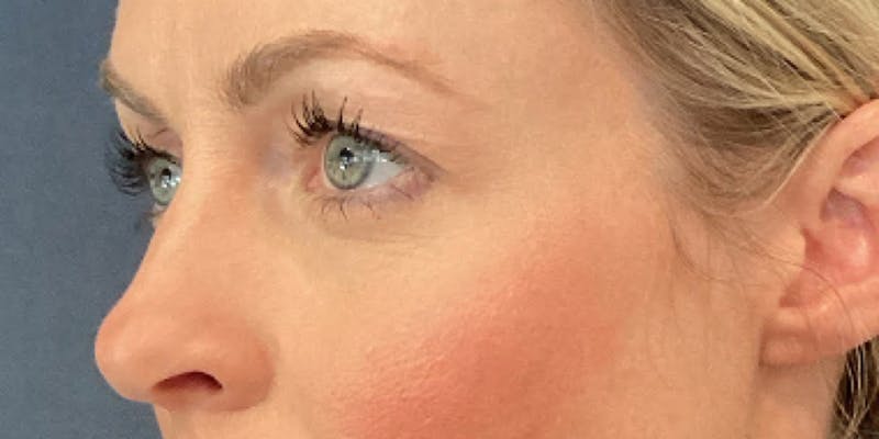 Blepharoplasty Before & After Gallery - Patient 317384 - Image 3