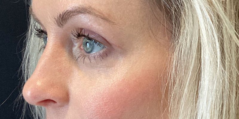 Blepharoplasty Before & After Gallery - Patient 317384 - Image 4