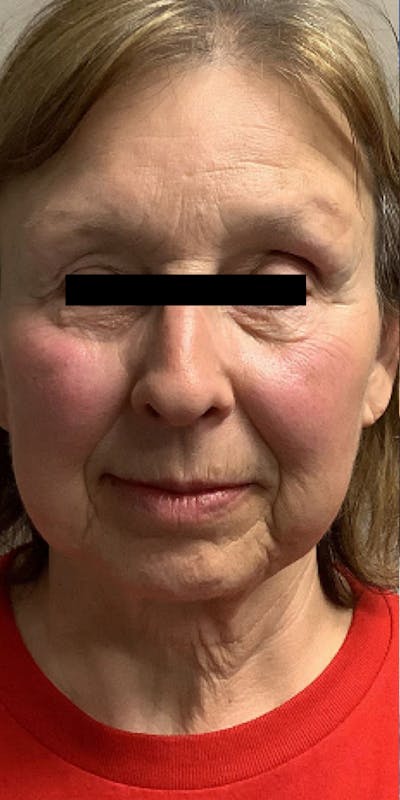 Blepharoplasty Before & After Gallery - Patient 310142 - Image 1