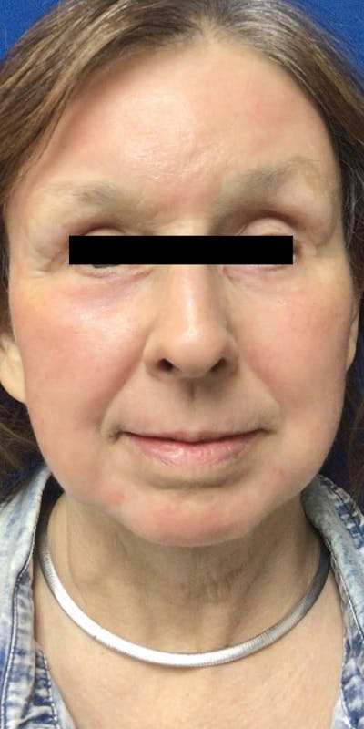 Blepharoplasty Before & After Gallery - Patient 310142 - Image 2
