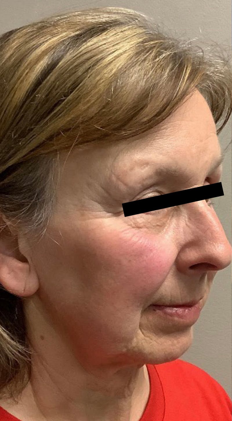 Blepharoplasty Before & After Gallery - Patient 310142 - Image 3