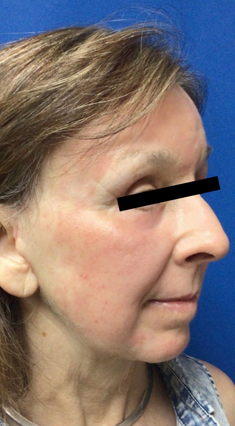 Blepharoplasty Before & After Gallery - Patient 310142 - Image 4