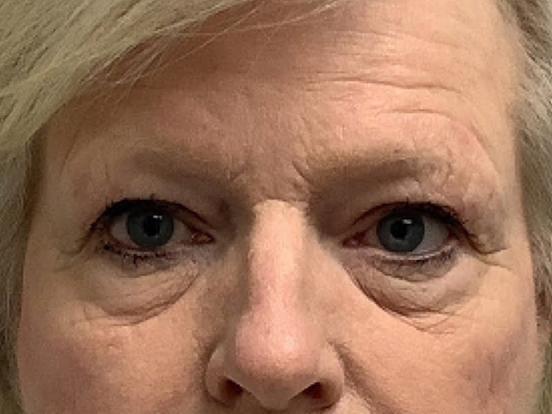 Blepharoplasty Before & After Gallery - Patient 270990 - Image 1