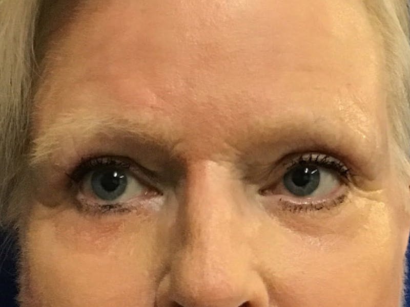 Blepharoplasty Before & After Gallery - Patient 270990 - Image 2