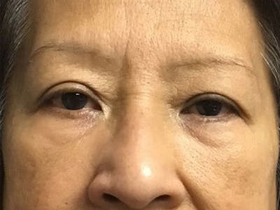 Blepharoplasty Before & After Gallery - Patient 272184 - Image 1