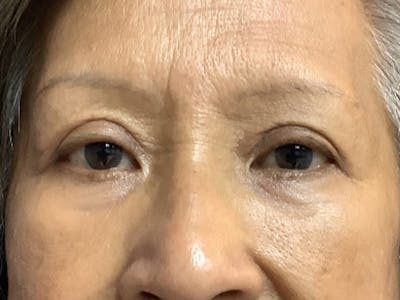 Blepharoplasty Before & After Gallery - Patient 272184 - Image 2