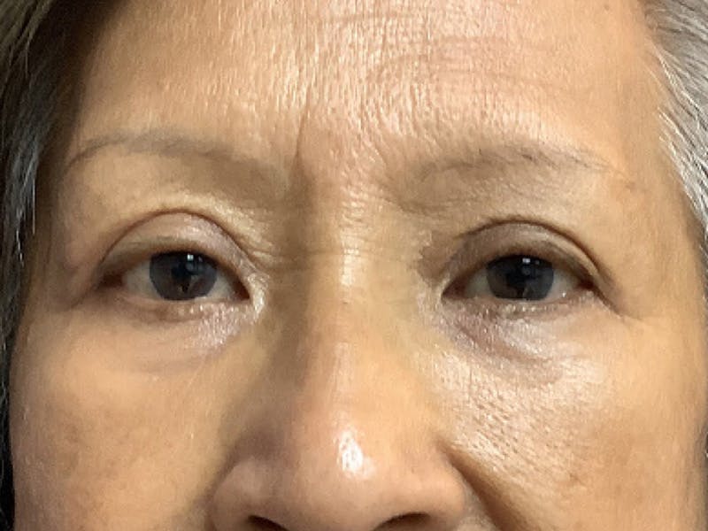 Blepharoplasty Before & After Gallery - Patient 272184 - Image 2