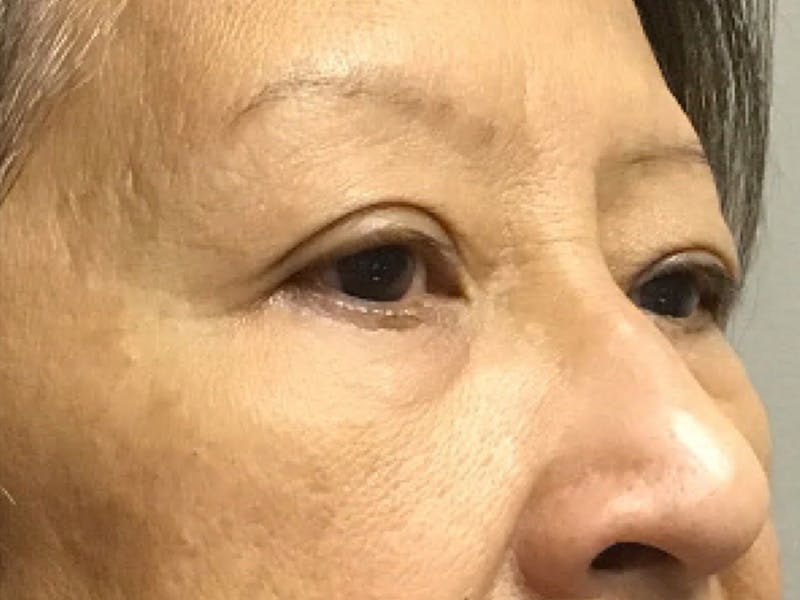 Blepharoplasty Before & After Gallery - Patient 272184 - Image 3