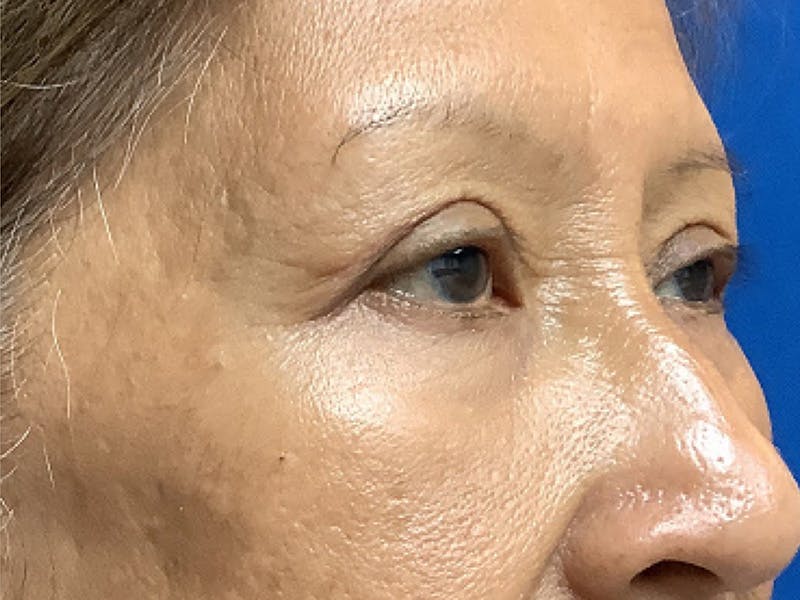 Blepharoplasty Before & After Gallery - Patient 272184 - Image 4