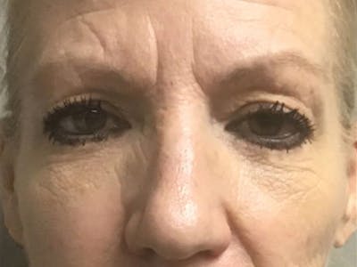 Blepharoplasty Before & After Gallery - Patient 195080 - Image 1