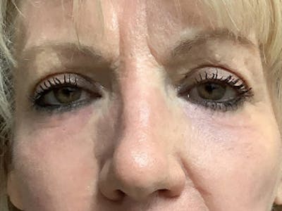 Blepharoplasty Before & After Gallery - Patient 195080 - Image 2