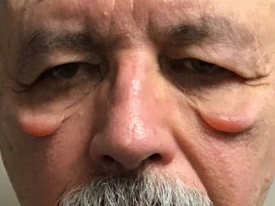 Blepharoplasty Before & After Gallery - Patient 350740 - Image 1