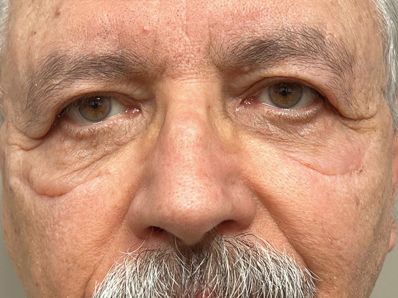 Blepharoplasty Before & After Gallery - Patient 350740 - Image 2