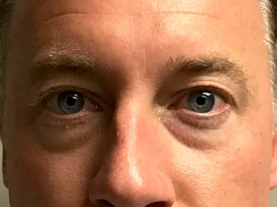 Blepharoplasty Before & After Gallery - Patient 321520 - Image 1
