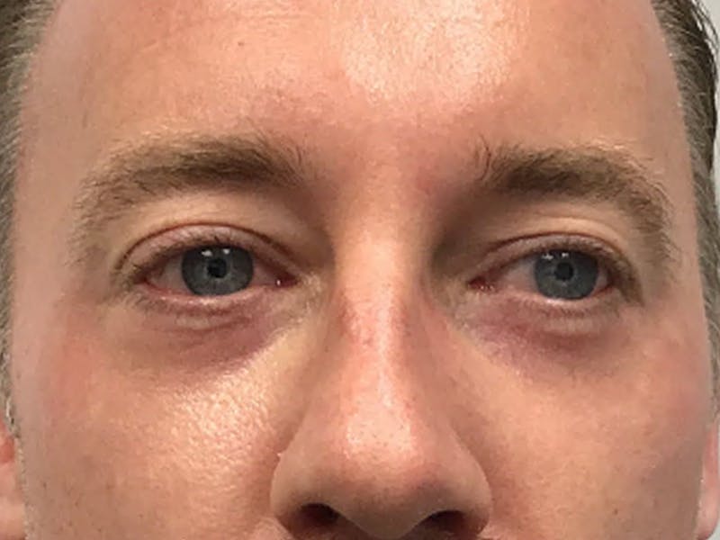 Blepharoplasty Before & After Gallery - Patient 321520 - Image 2